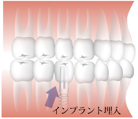 インプラントの埋入