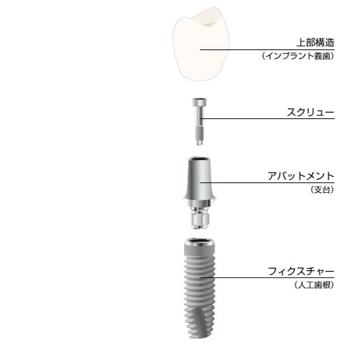 インプラントとは