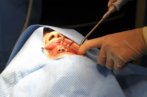 その４．骨が薄い方への治療対応力