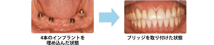 4本のインプラントを埋め込んだ状態