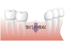 複数歯の欠損