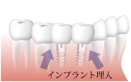 複数インプラントの埋入