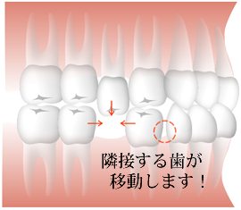 単歯欠損