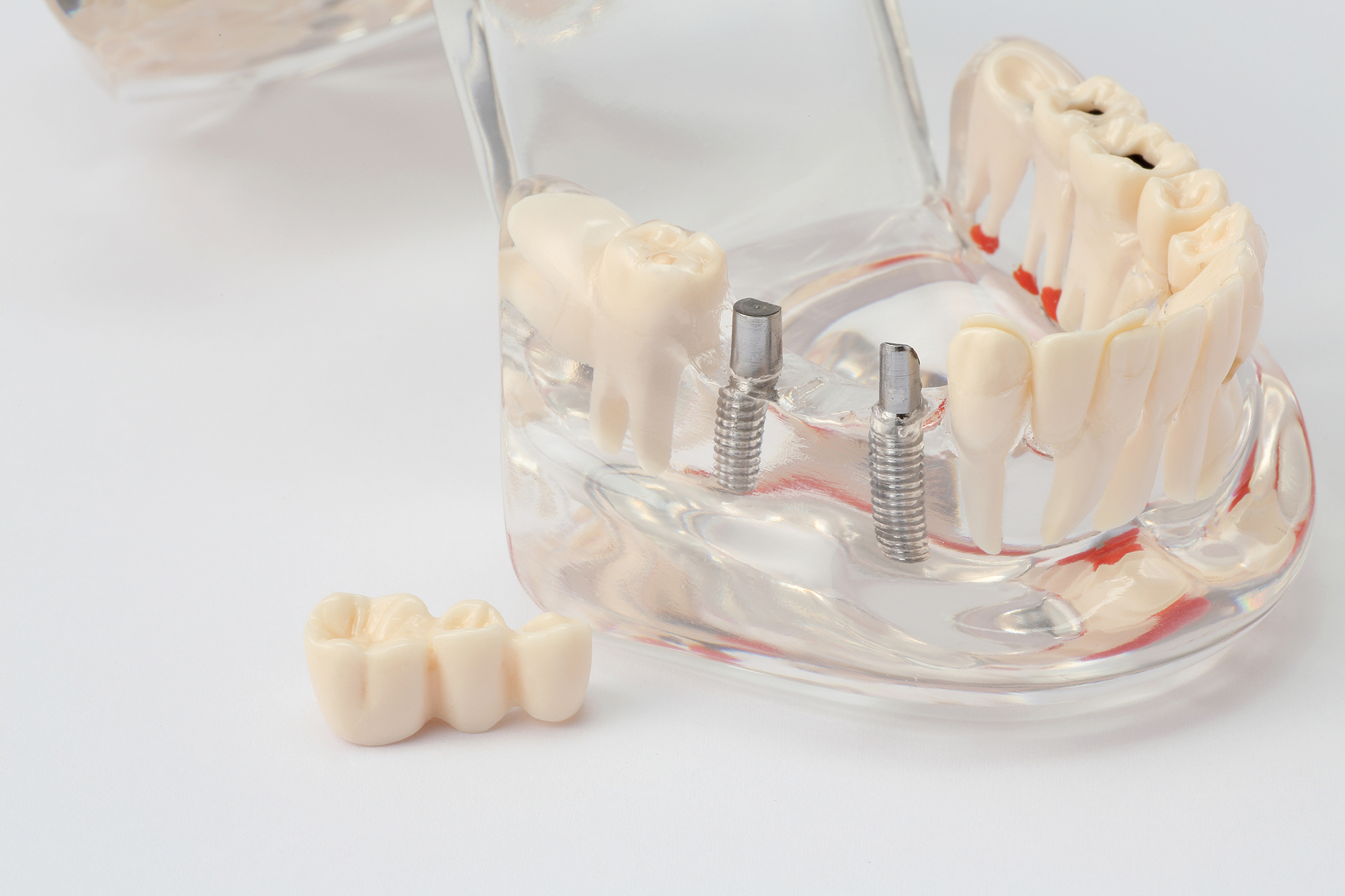 人工の歯が壊れることはありますか？