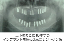 上下のあごに10本ずつインプラントを埋め込んだレントゲン像