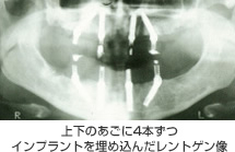 上下のあごに4本ずつインプラント埋め込んだレントゲン像