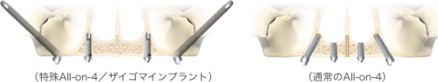 ザイゴマインプラント