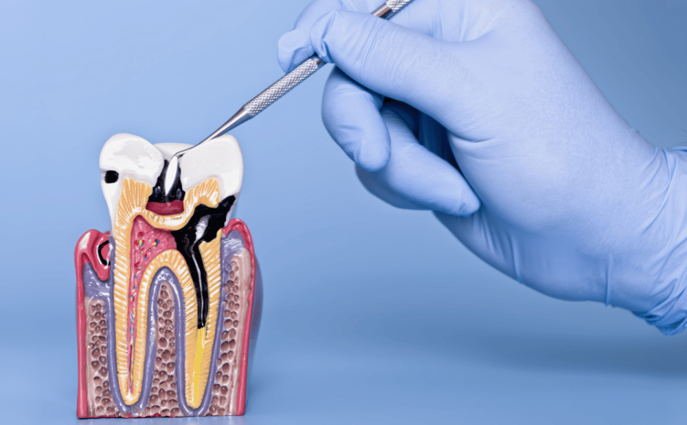 矯正中は外出先でも歯磨きが必要な理由