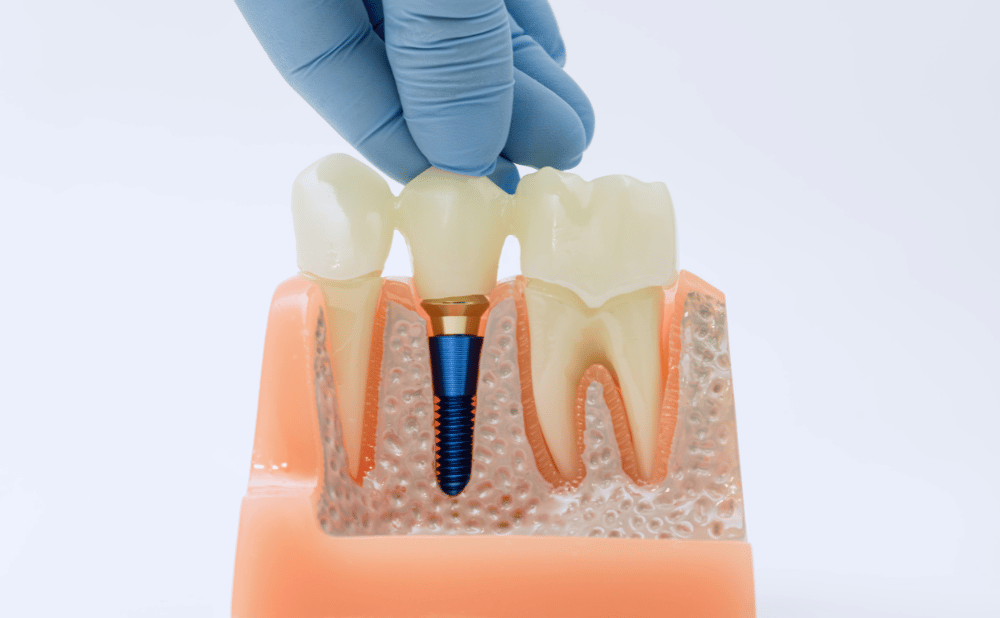 東郷町から通えるインプラント治療ができる5医院！
