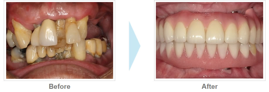名古屋でオールオン4のインプラント治療なら名駅歯科クリニック 矯正歯科